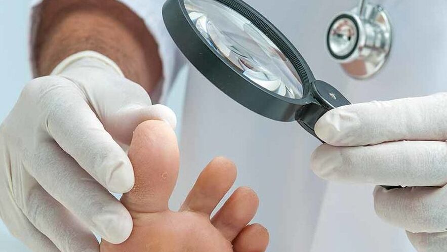Die Diagnose eines Zehennagelpilzes wird von einem Dermatologen gestellt