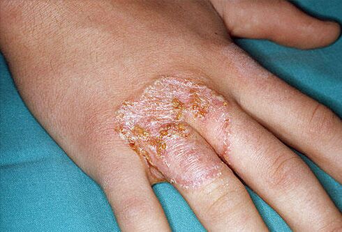Halskettenförmige rote Flecken auf der Haut der Hände aufgrund von Mykose