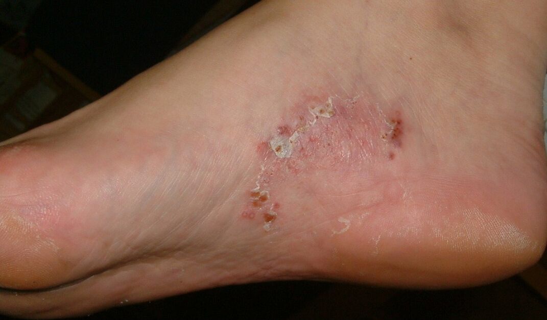 Manifestationen einer Pilzinfektion am Fuß
