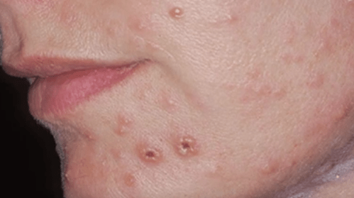 Pilzinfektion der Haut im Gesicht