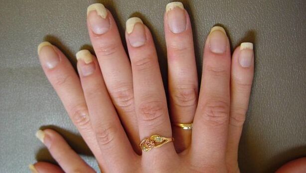 Von einer Pilzinfektion betroffene Fingernägel